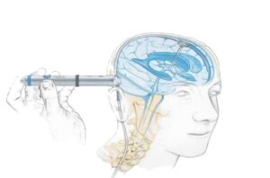 Gravity valves for hydrocephalus treatment: new study confirms their effectiveness