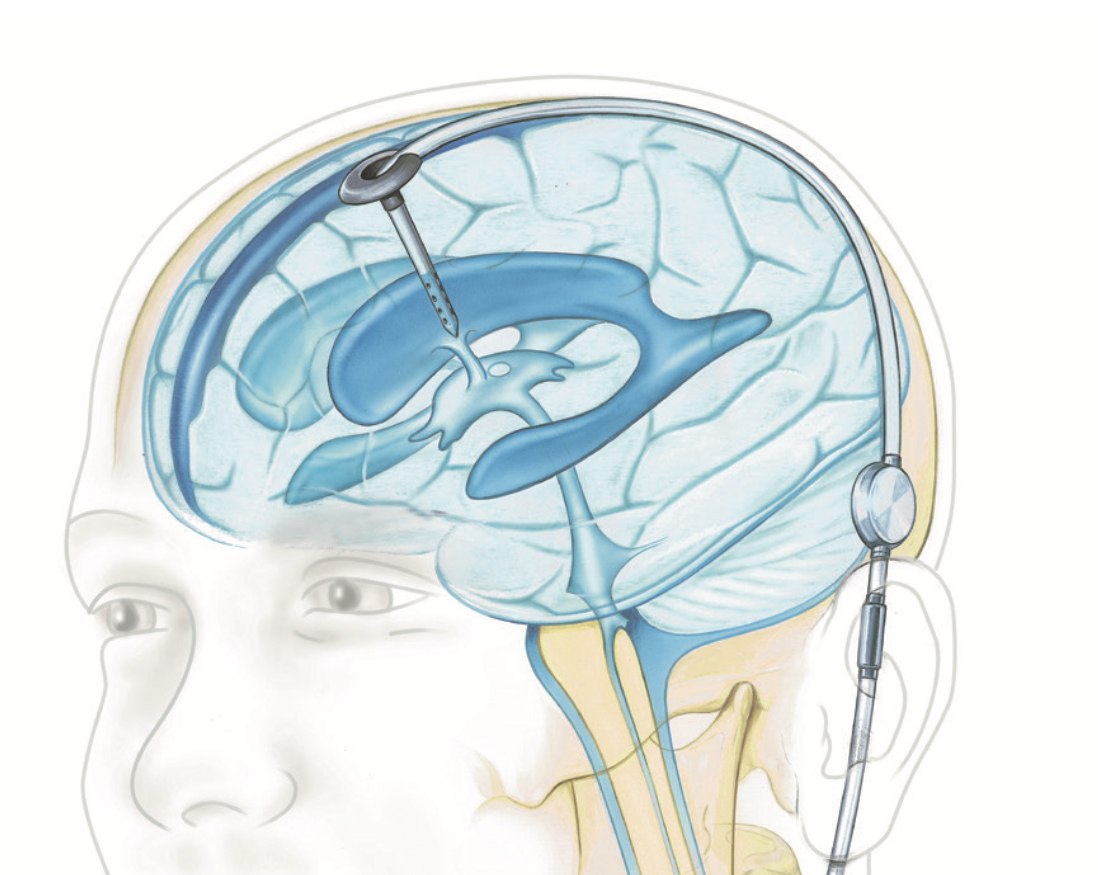 Normal-pressure hydrocephalus: a reversible dementia you shouldn’t miss